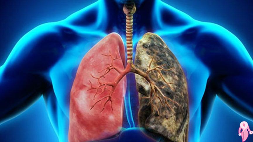 Akciğer Kanserinin İlk Bulguları Nelerdir, Nasıl Anlaşılır?