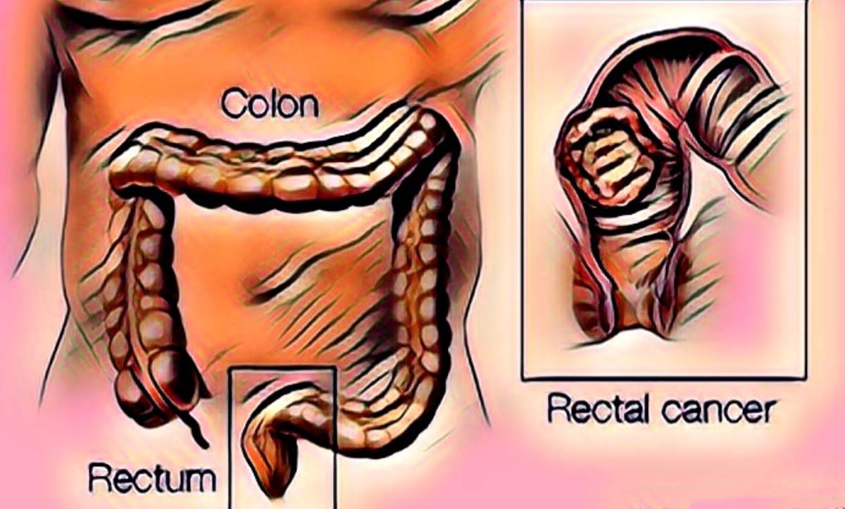 Kalın Bağırsak Kanseri Belirtileri