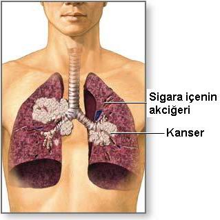 Akciğer Kanseri - Yayılımı Ve Karmaşıklıkları