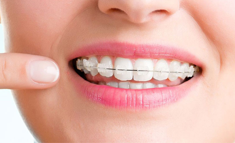 Diş teli temizliği nasıl yapılmalıdır?